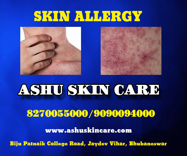 best skin allergy treatment clinic in bhubaneswar near me